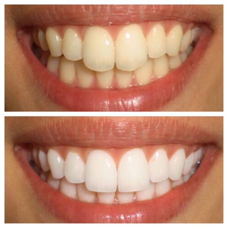 our client show theet before quality and after