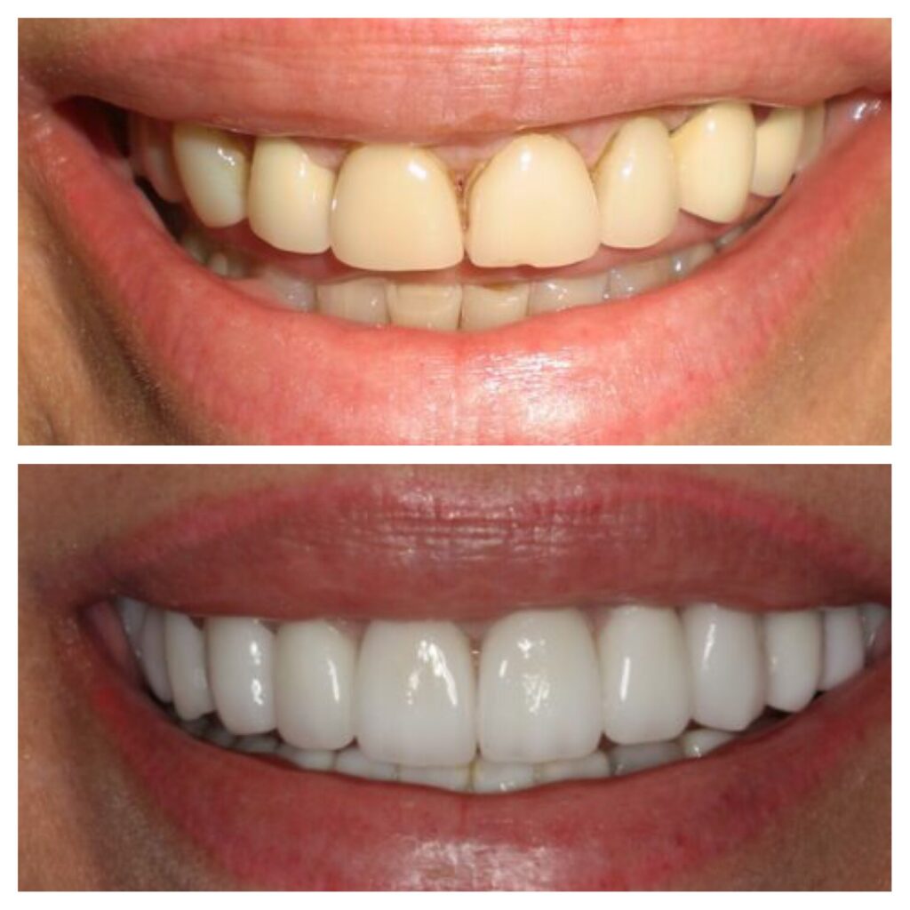 our client show theet before quality and after