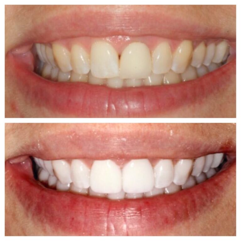 our client show theet before quality and after