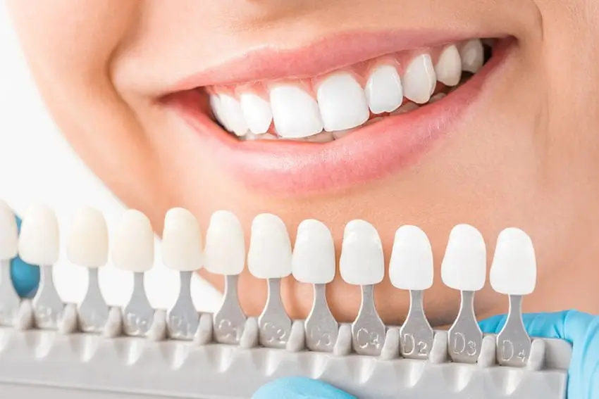 Porcelain Dental Veneers in Fort Lauderdale