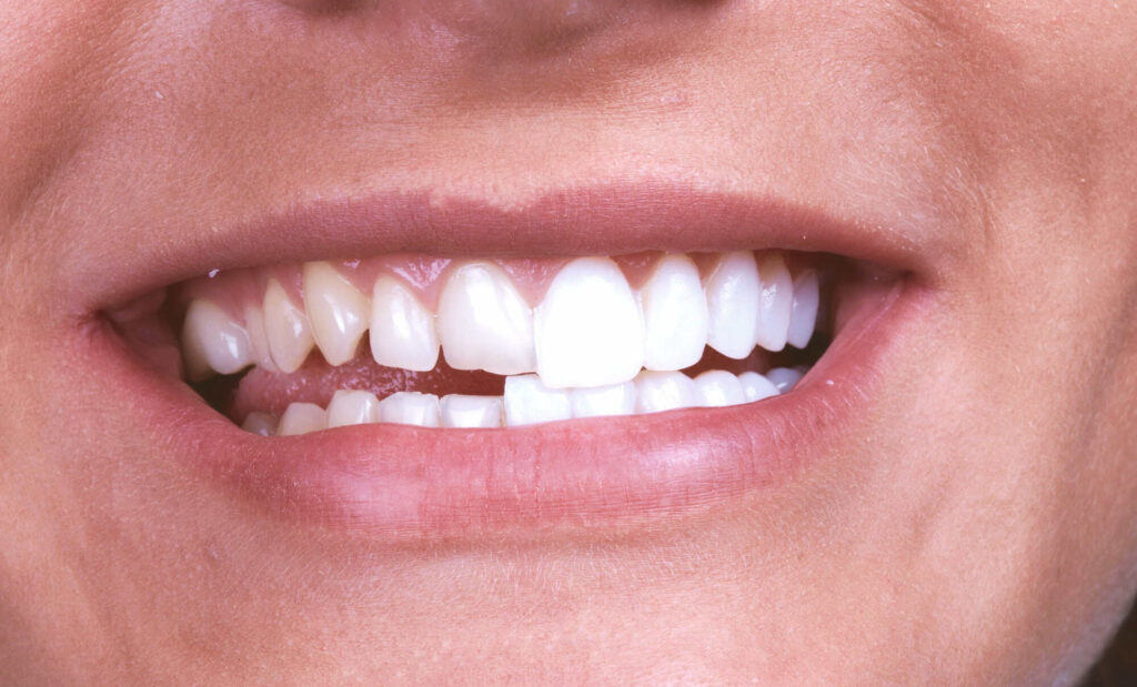 Dental Veneers