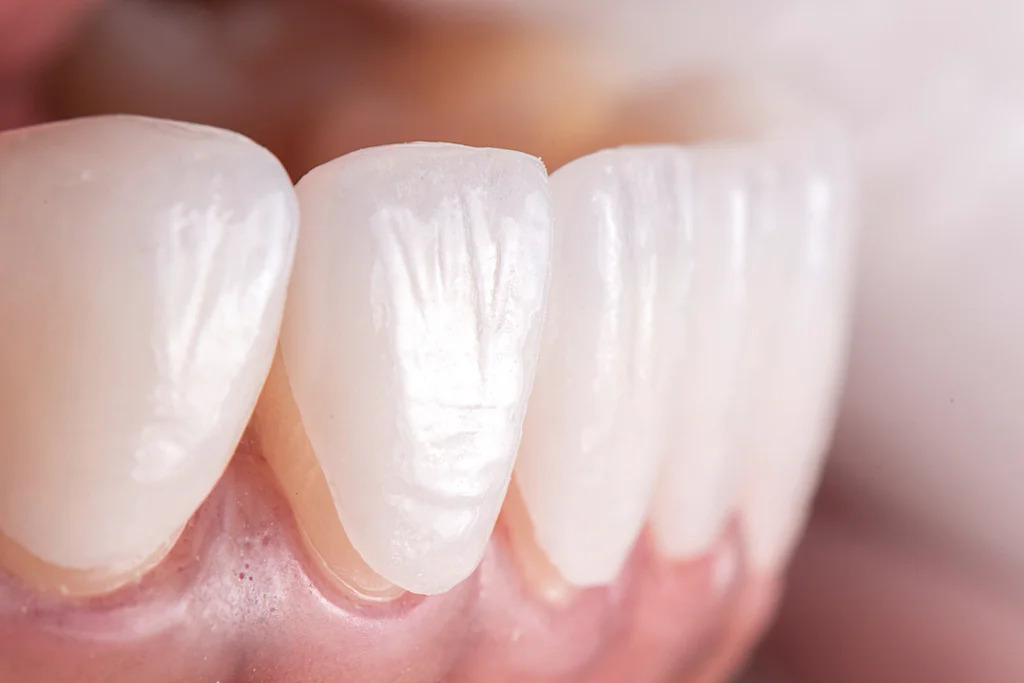 Porcelain veneers