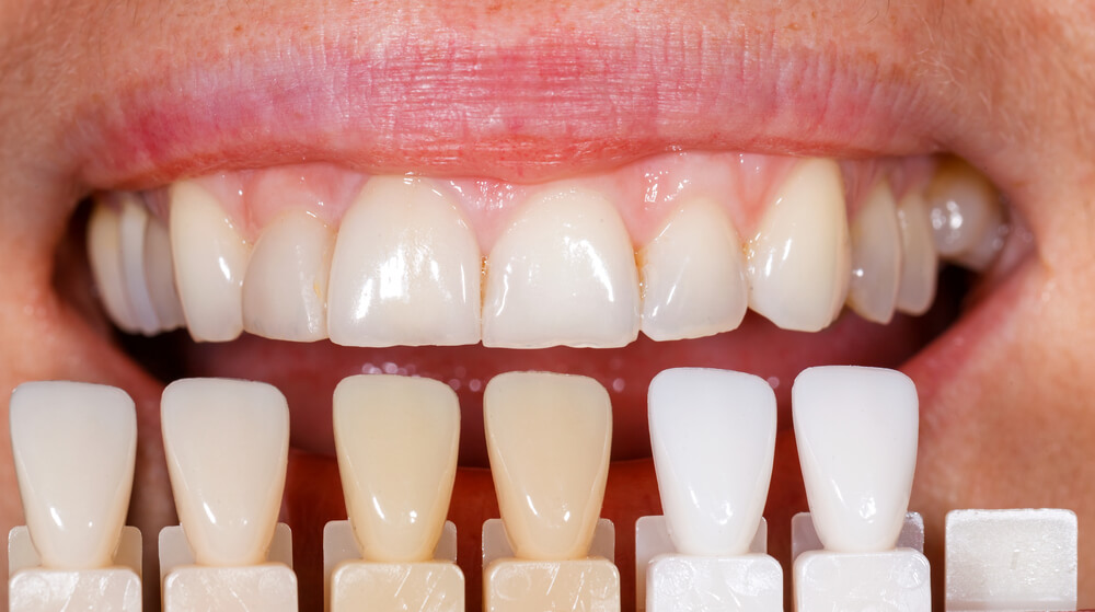 Dental Veneers vs. Crowns