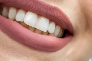 dental veneers