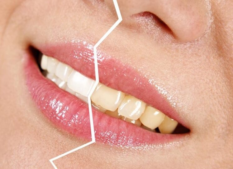 Common Reasons to Whiten Your Teeth