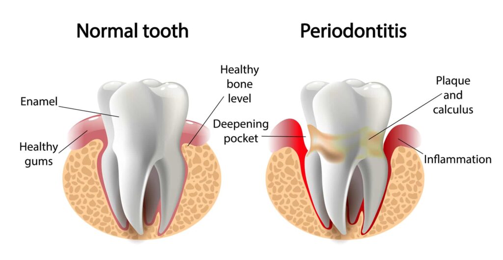 Common Symptoms of Periodontitis