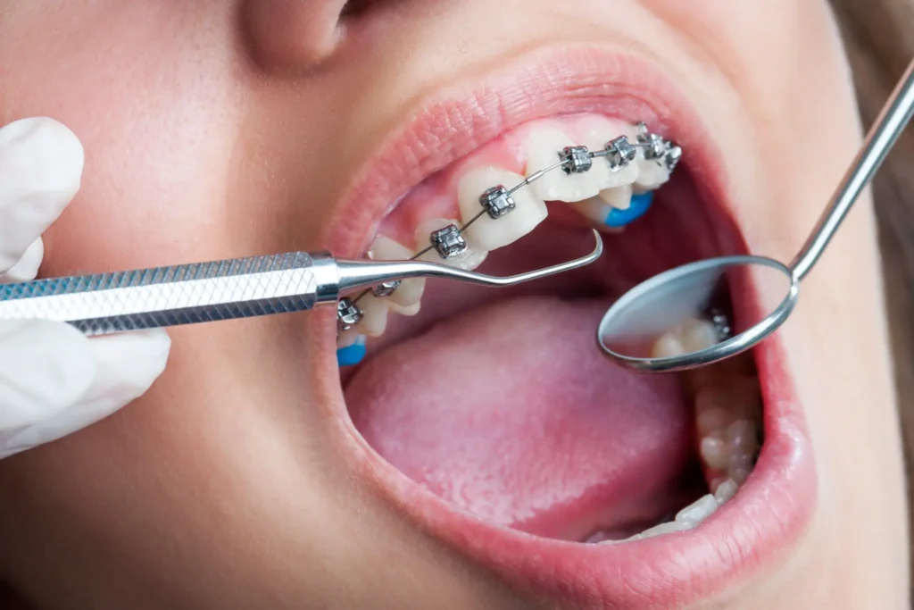 Orthodontist Fort Lauderdale