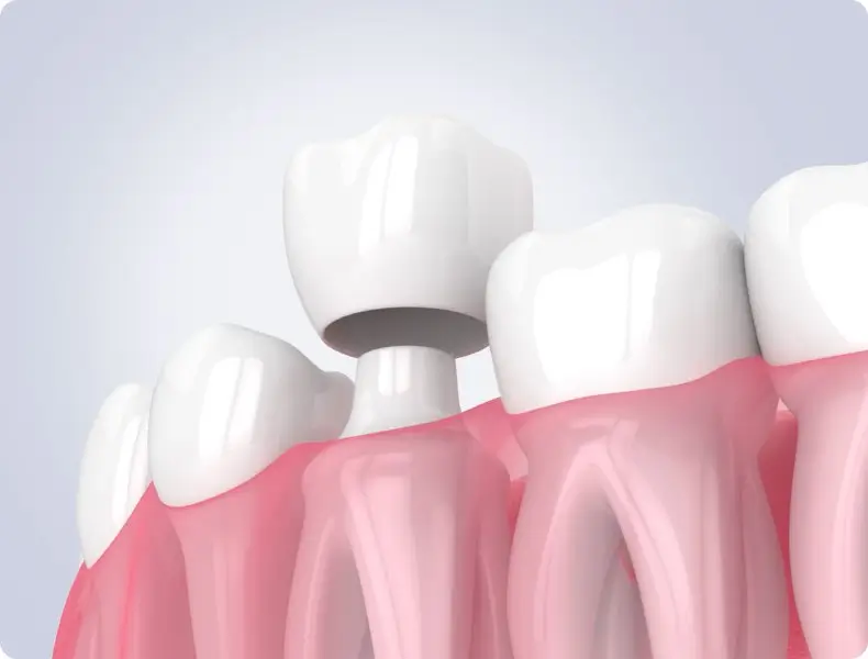 Dental Crowns Fort Lauderdale FL