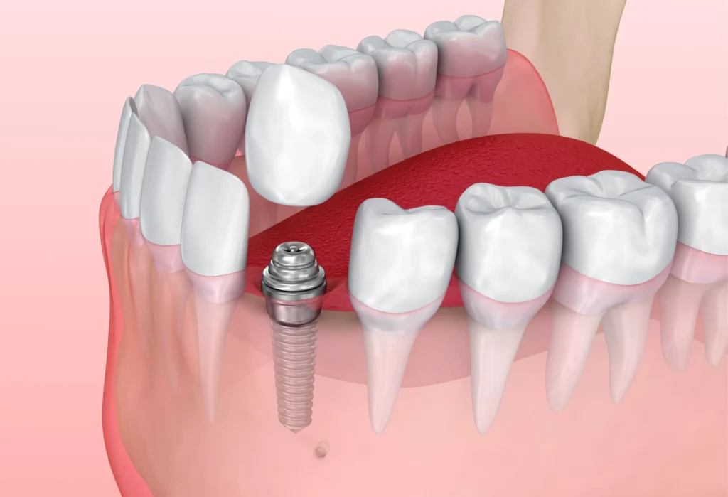 Fort Lauderdale Dental Crowns