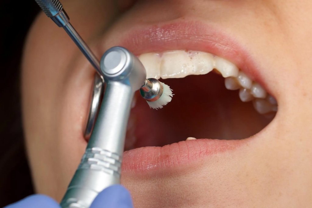 Dental Implant Services in Fort Lauderdale