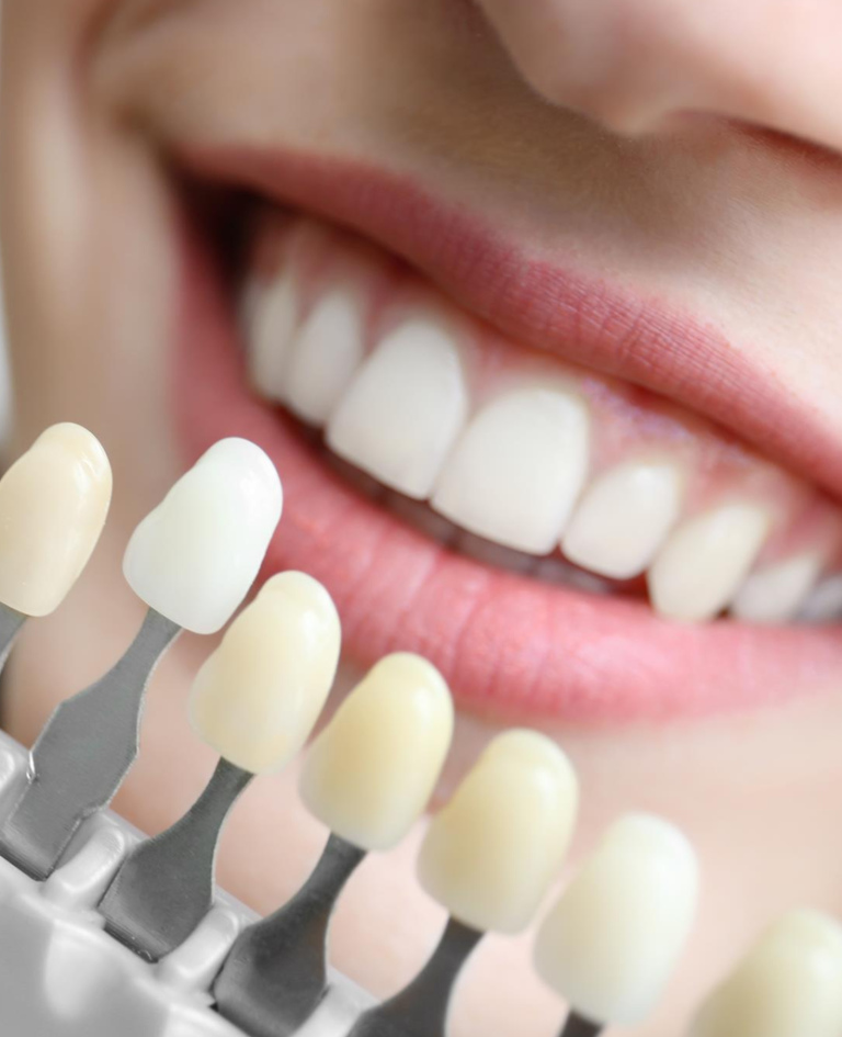 Porcelain Veneers in Fort Lauderdale, FL