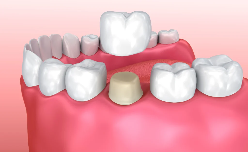 Cosmetic dental crowns Fort Lauderdale