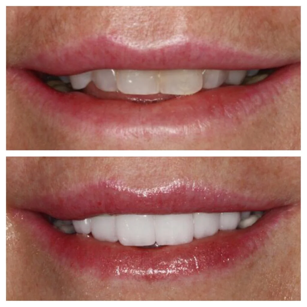 Mini dental implants Fort Lauderdale