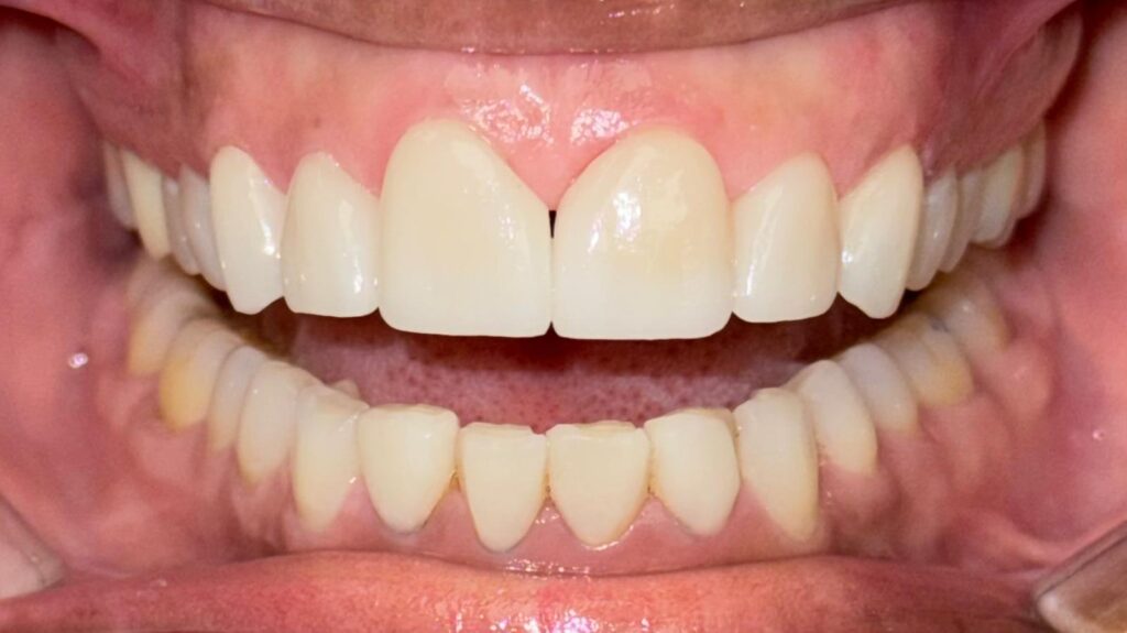 Porcelain Veneers in Fort Lauderdale