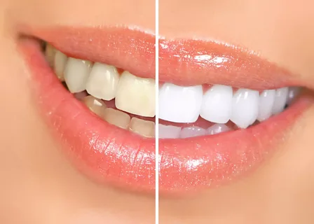 cosmetic dentist in Fort Lauderdale